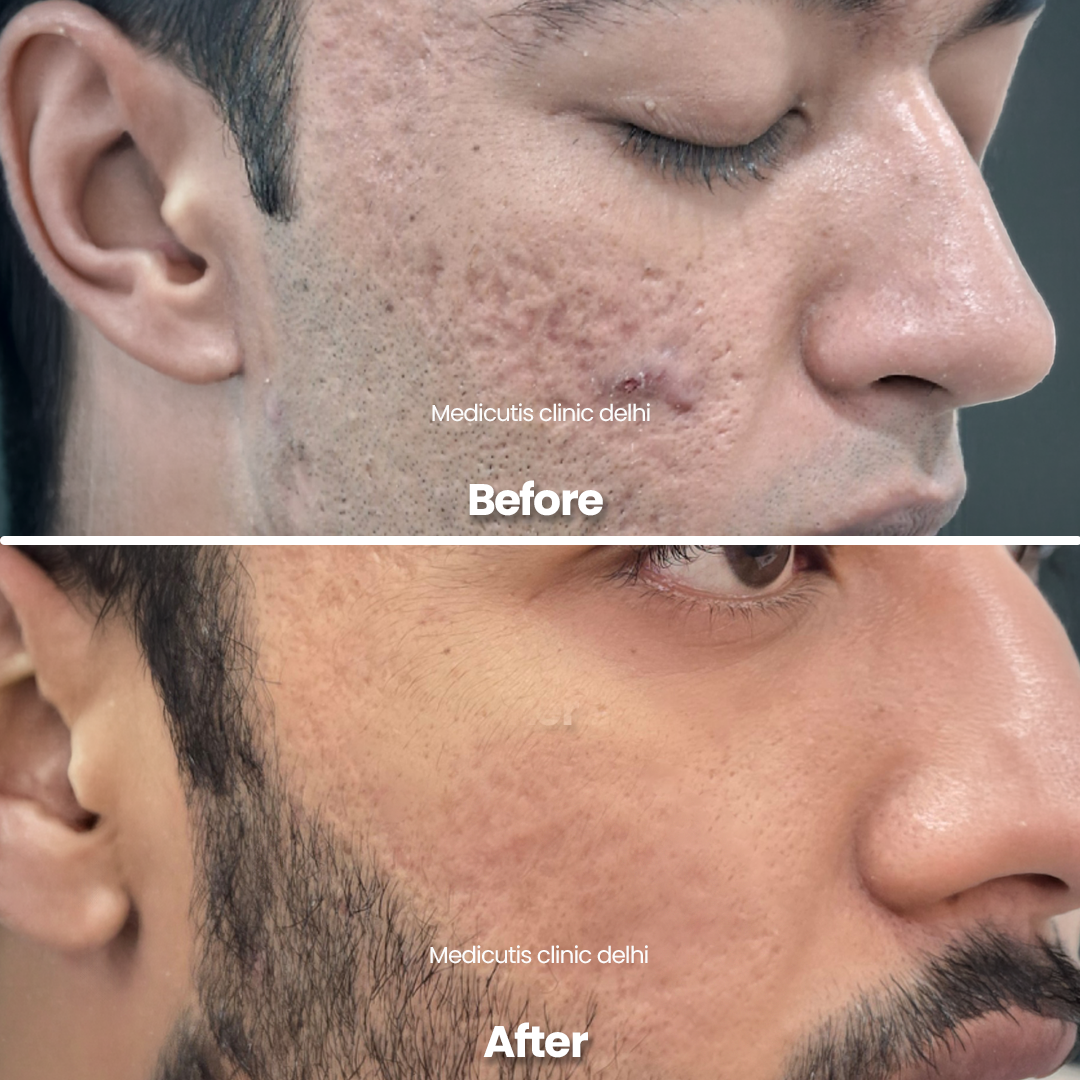 1 Acne Scars & Texture Correction