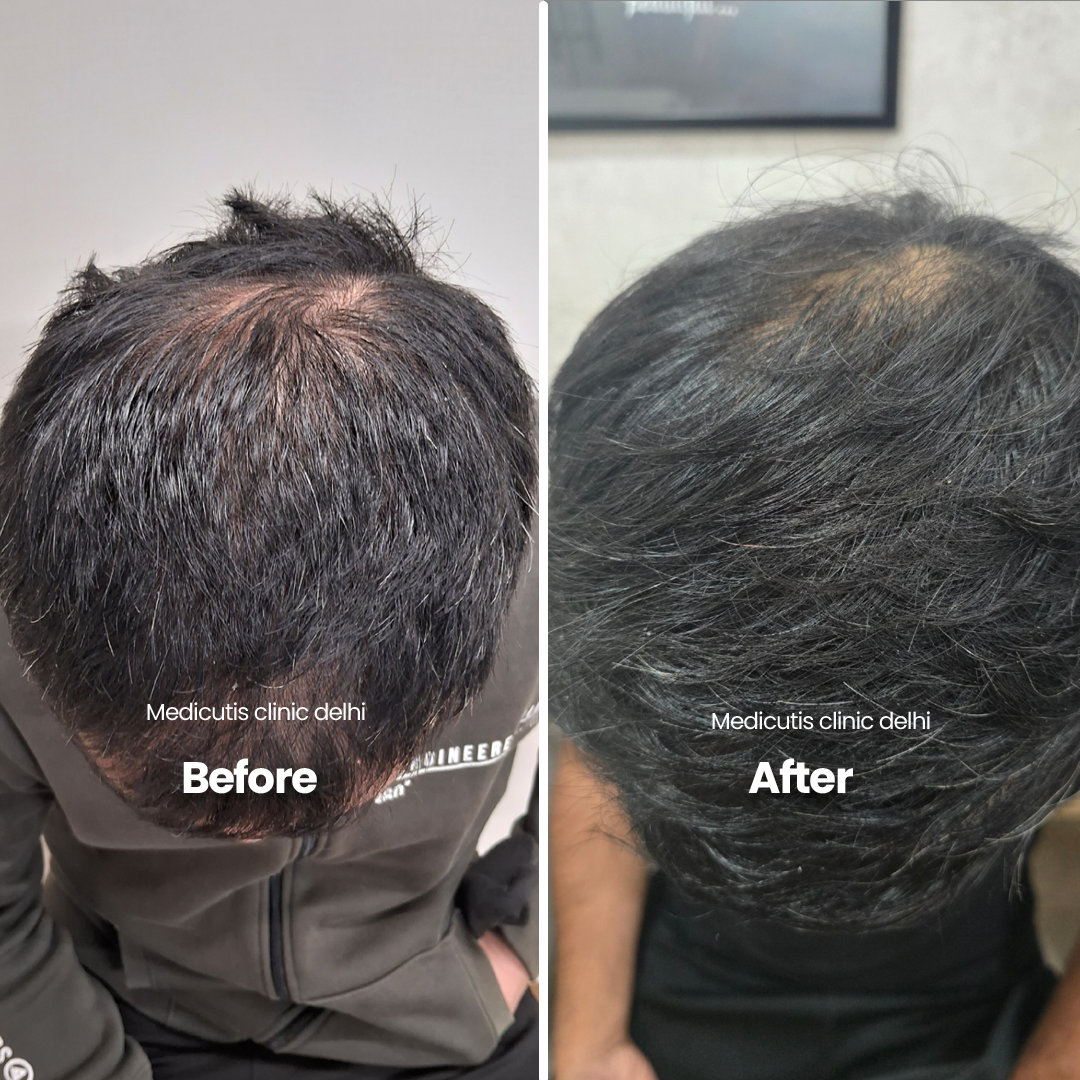 1 Hair Thinning