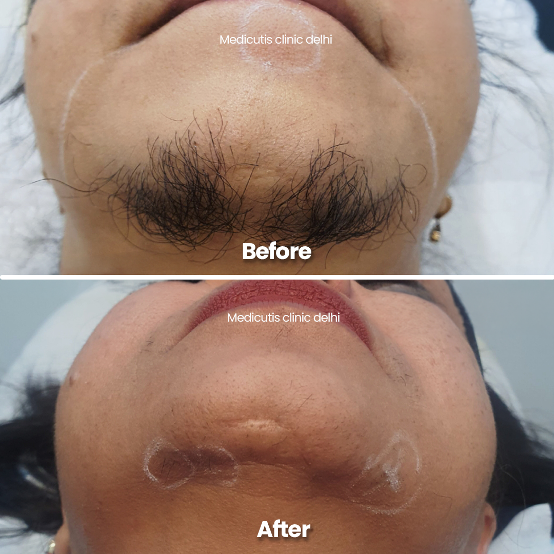 1 Laser for Unwanted Hair