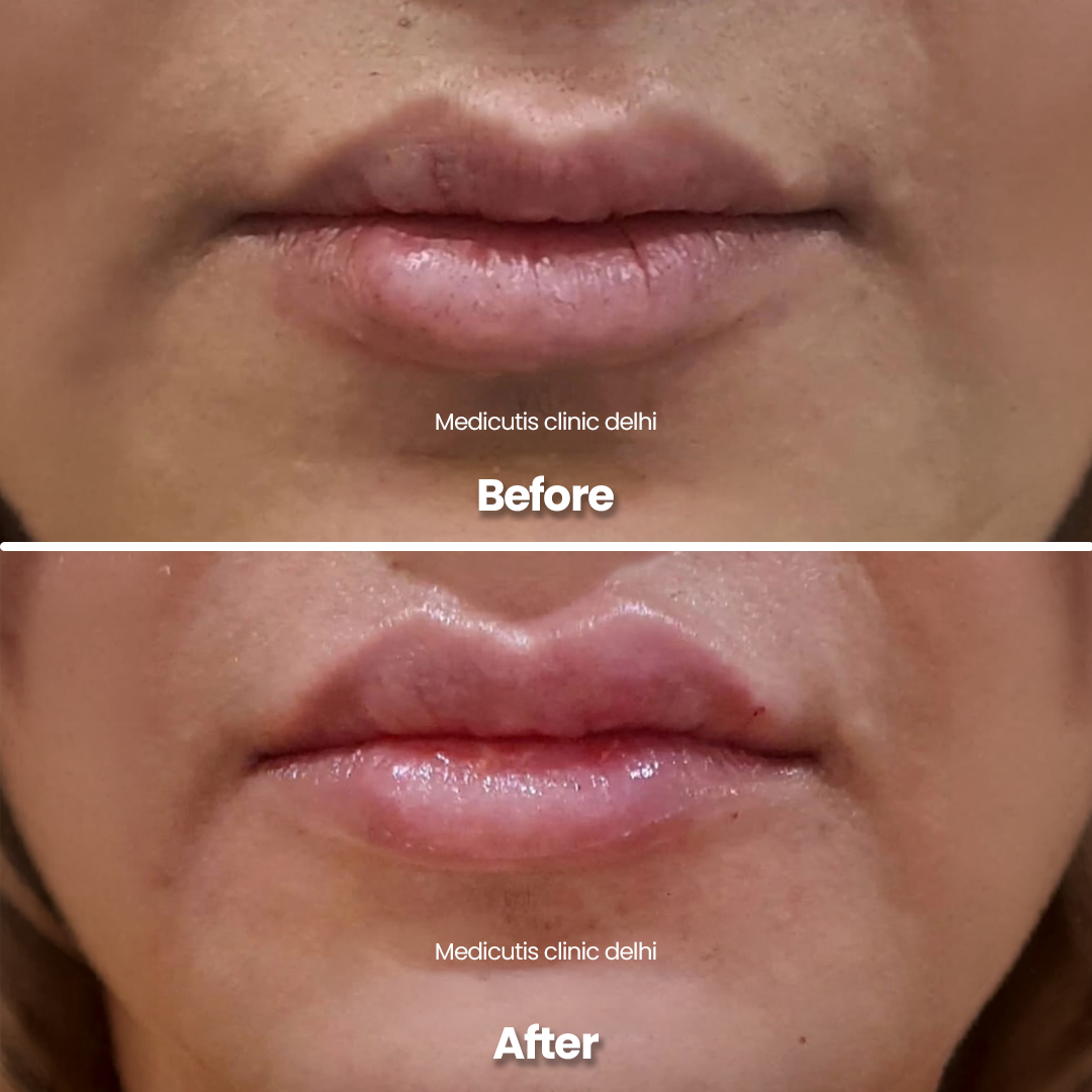 1 Lip Rejuvenation & Enhancement