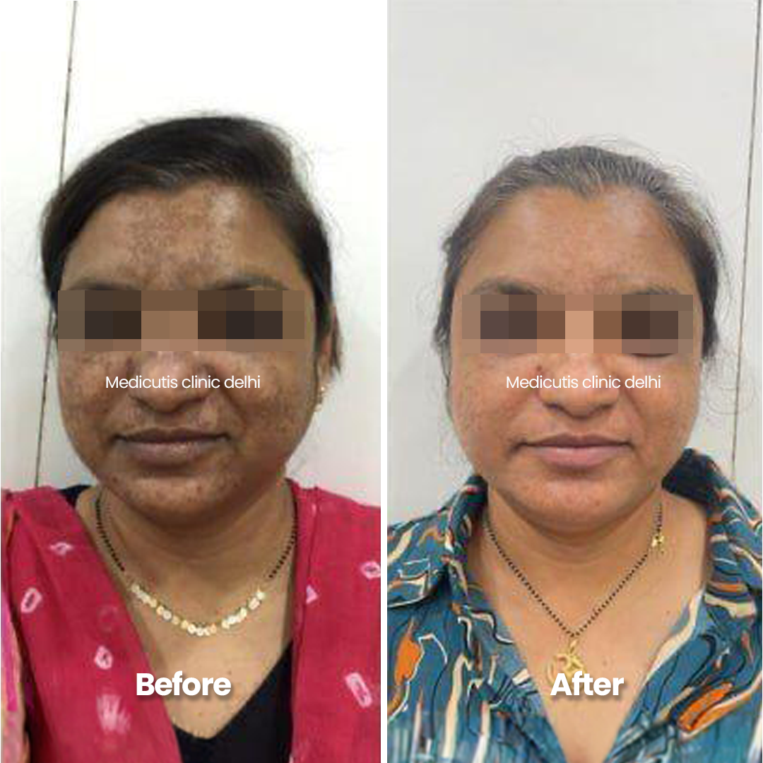 1 Skin Regeneration