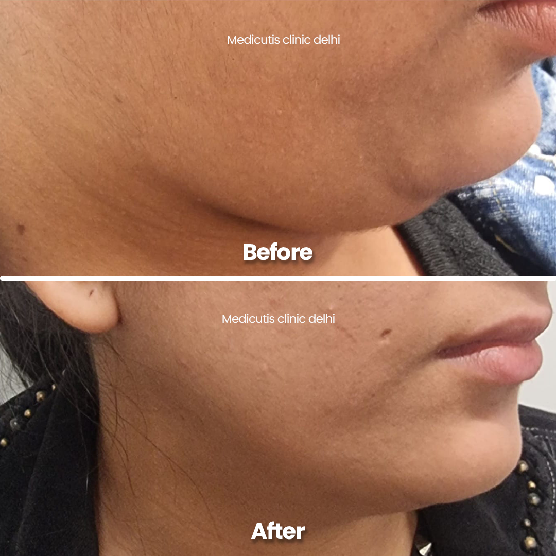 1 Skin Tightening & Lifting