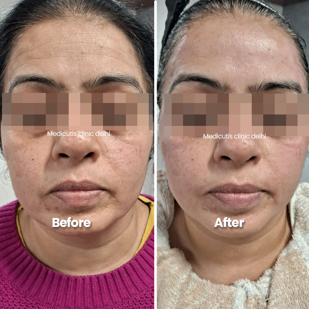 1 Wrinkles, Sagging & volume