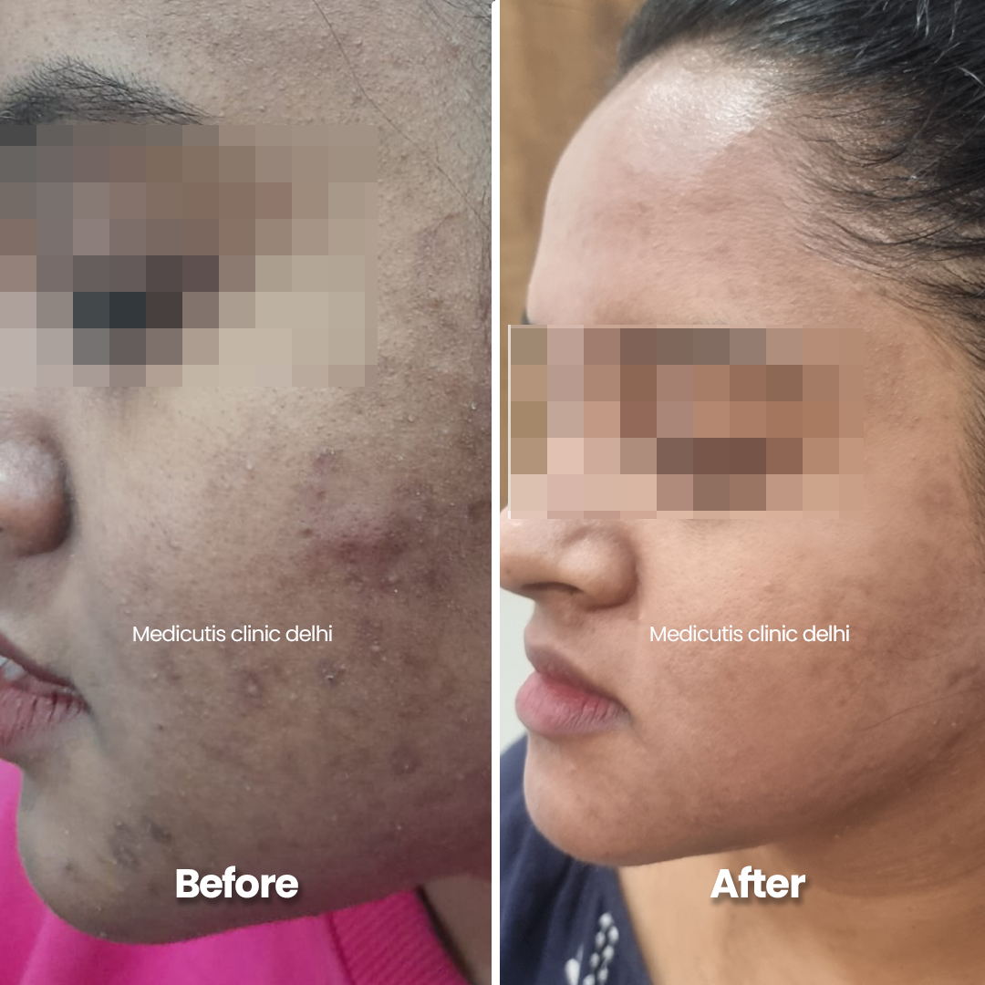 10 Acne Scars & Texture Correction