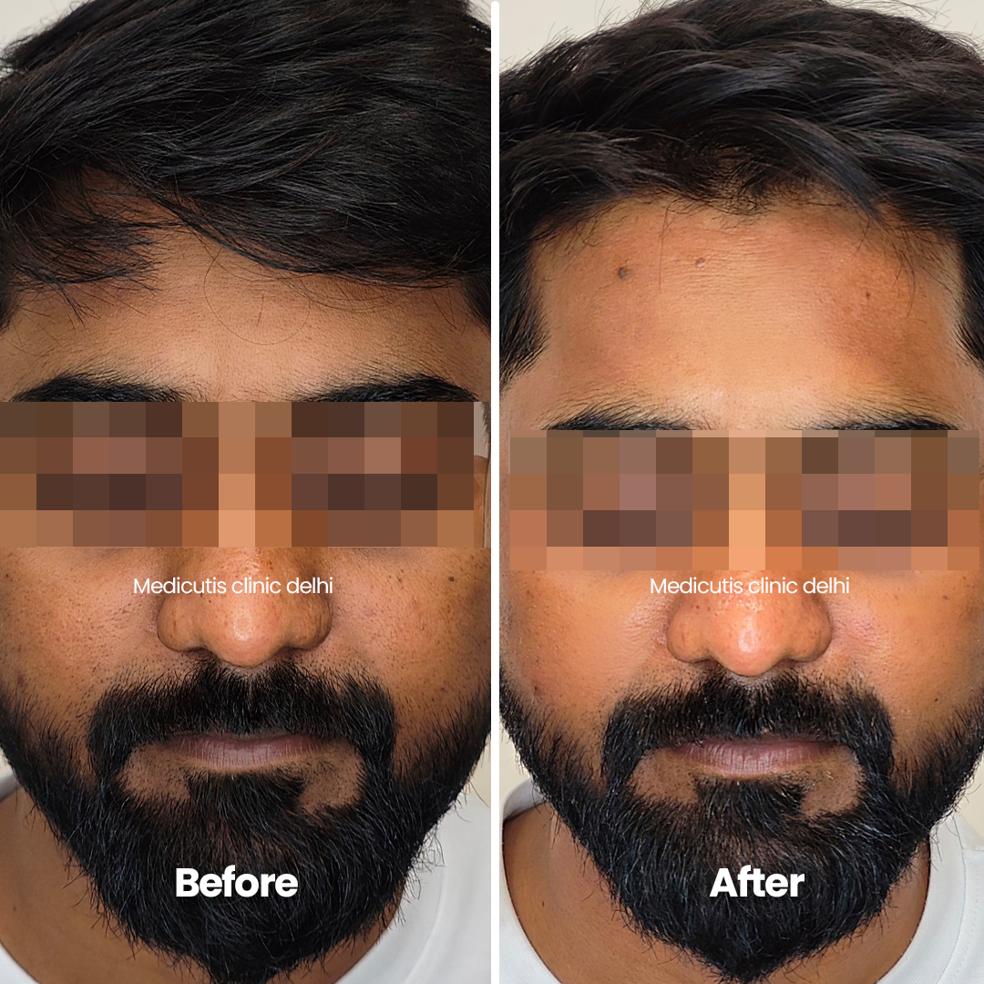 2 Acne Scars & Texture Correctionpng