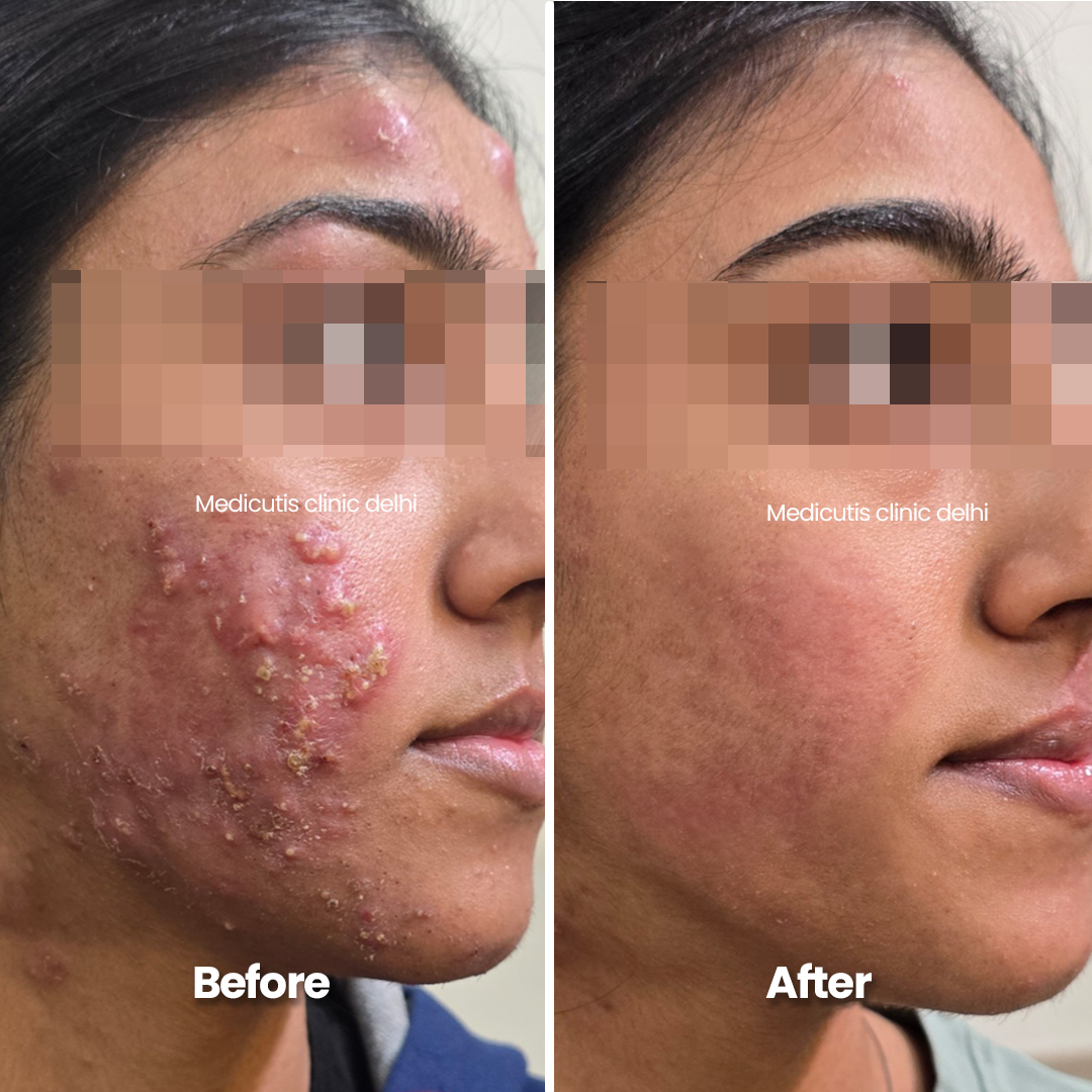 2 Edit Acne