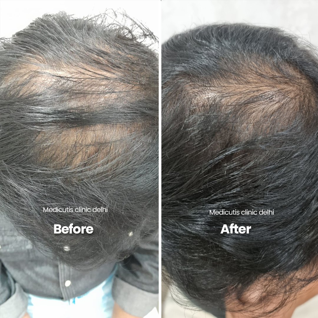 2 Hair Thinning