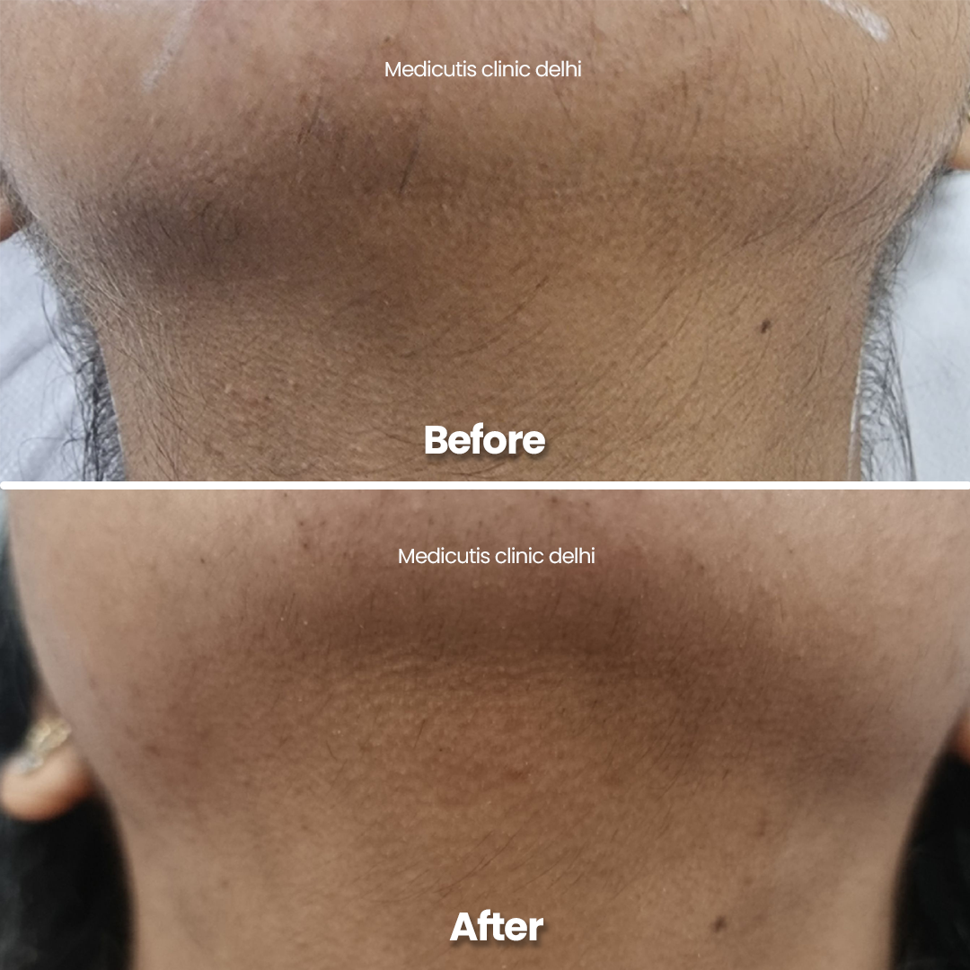 2 Laser for Unwanted Hair