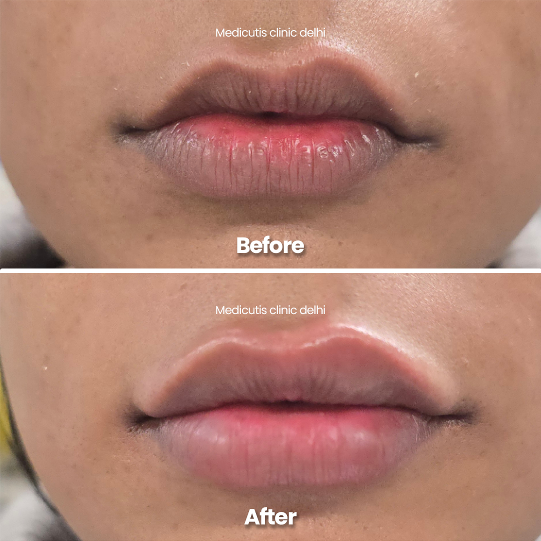 2 Lip Rejuvenation & Enhancement