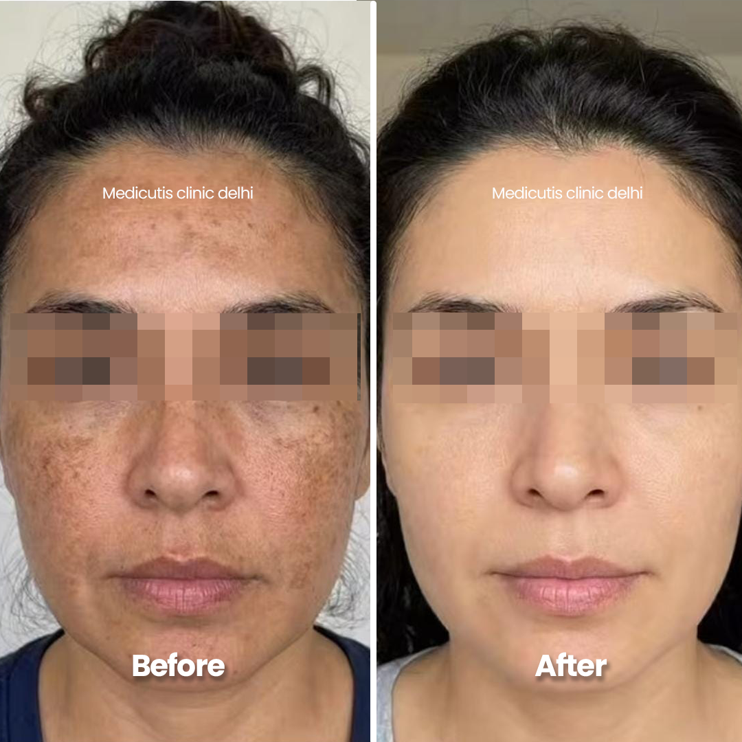 2 Skin Regeneration