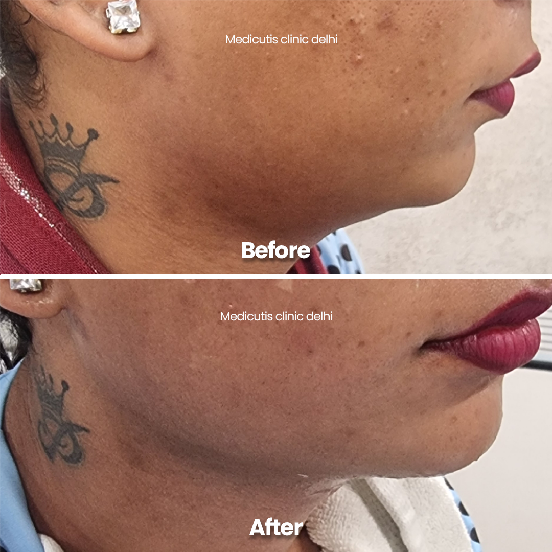 2 Skin Tightening & Lifting