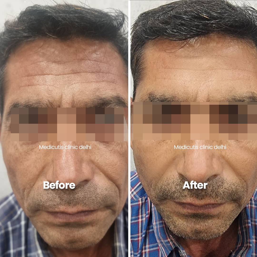 2 Wrinkles, Sagging & volume