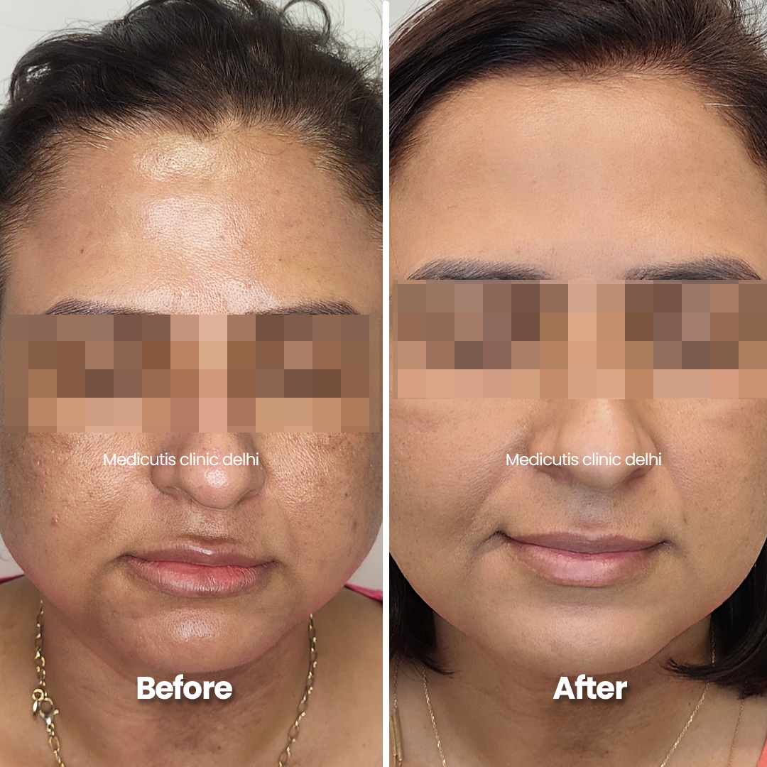 3 Acne Scars & Texture Correctionpng