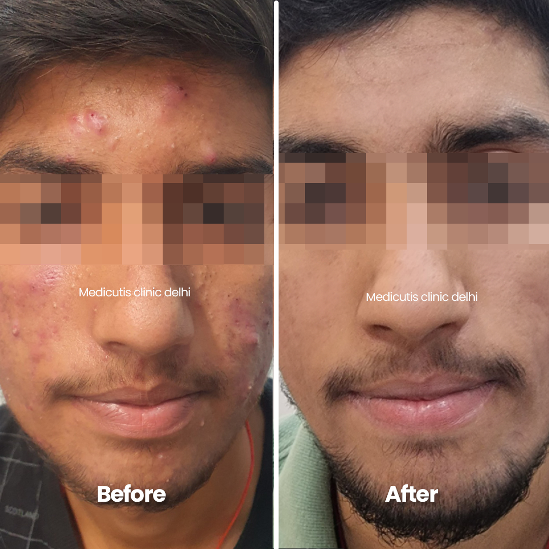 3 Edit Acne