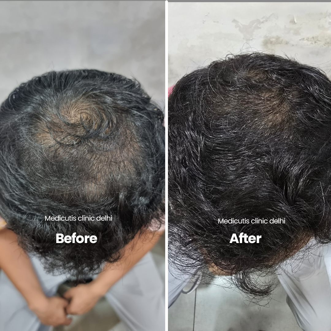 3 Hair Thinning