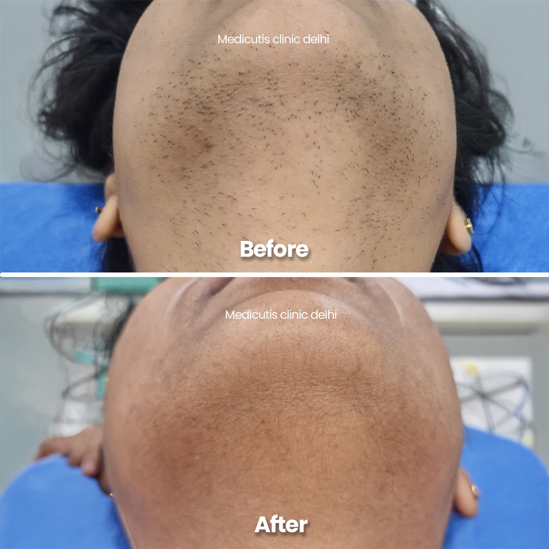 3 Laser for Unwanted Hair