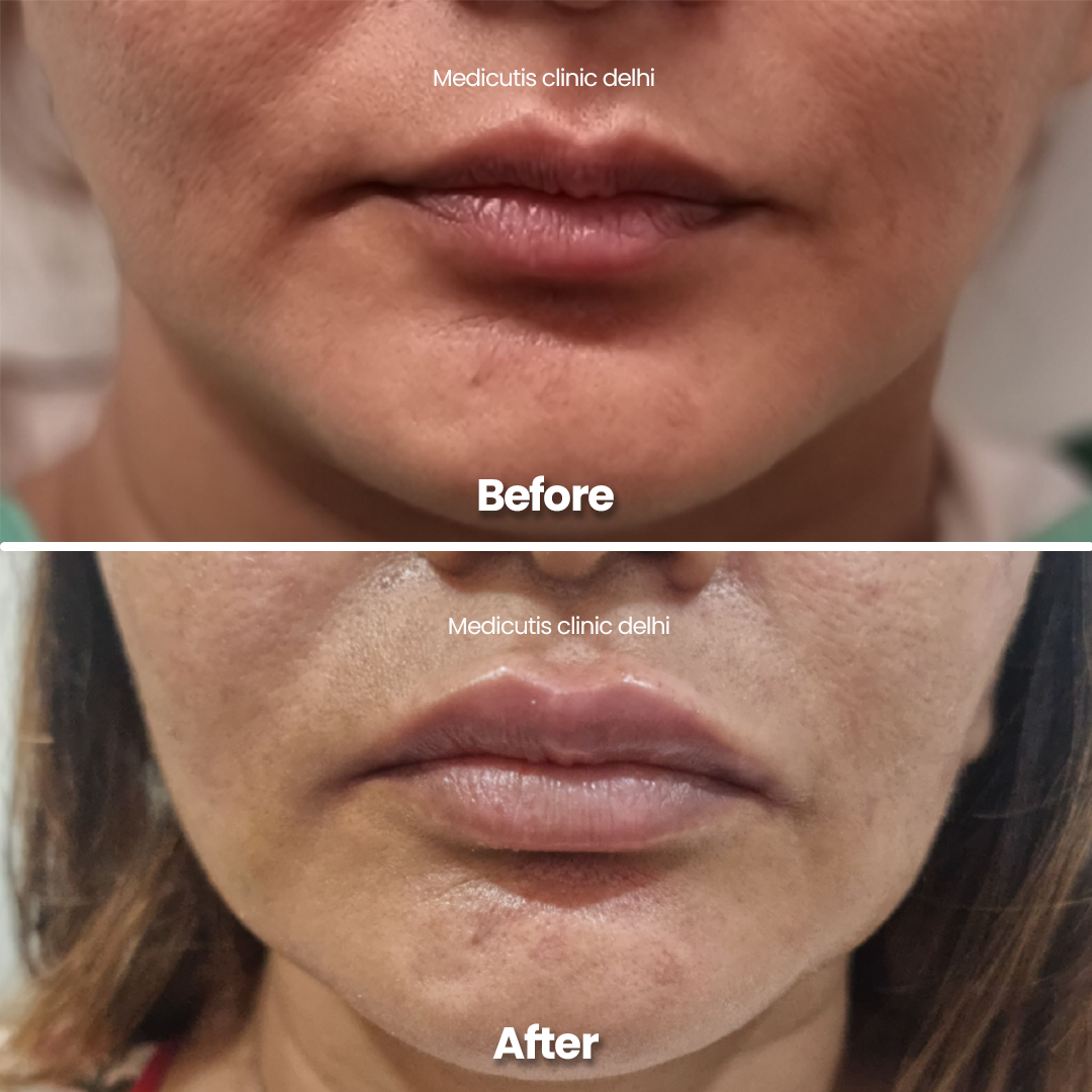 3 Lip Rejuvenation & Enhancement