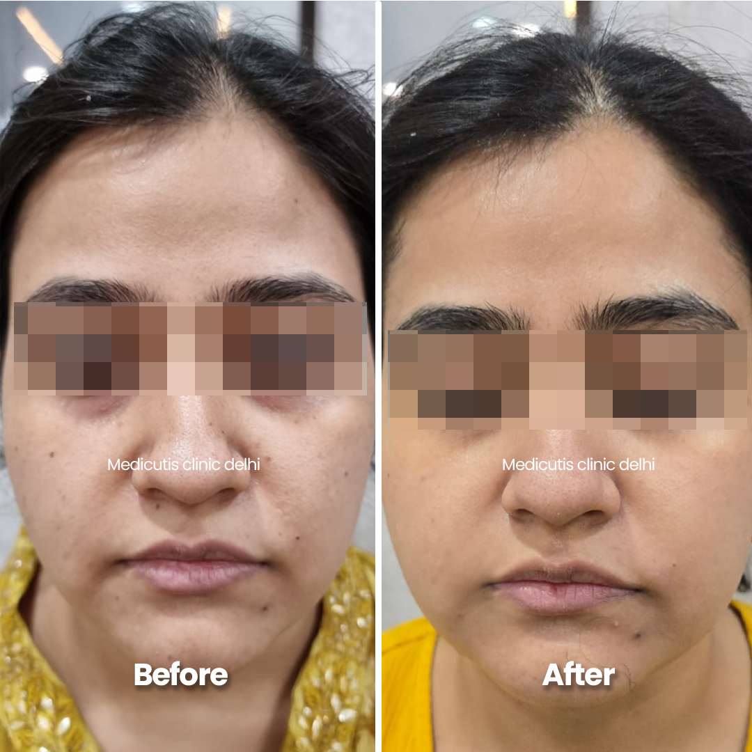 3 Skin Regeneration