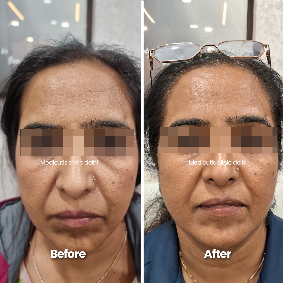 3 Skin Tightening & Lifting