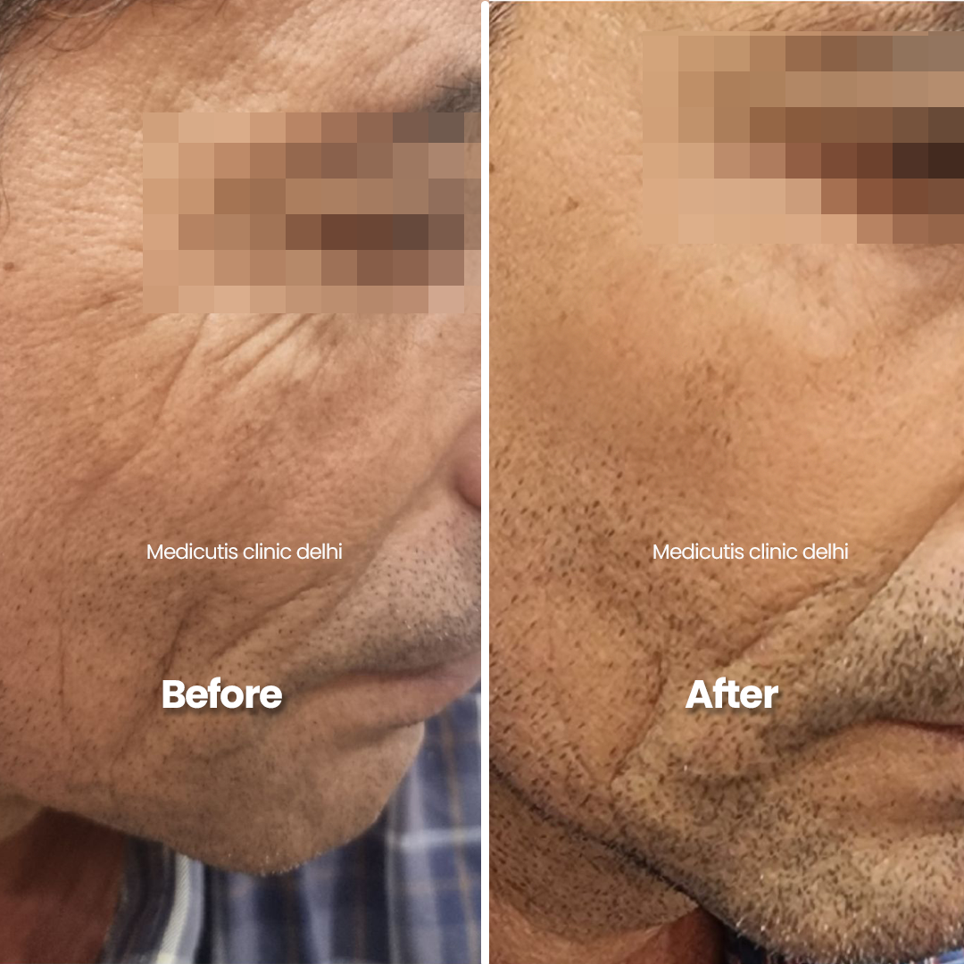 3 Wrinkles, Sagging & volume