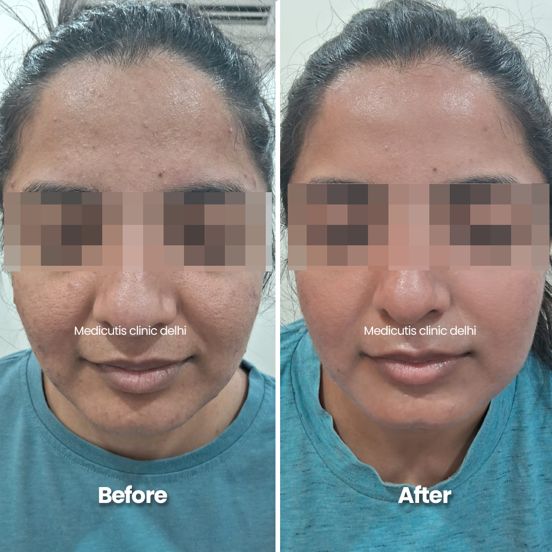 4 Acne Scars & Texture Correctionpng