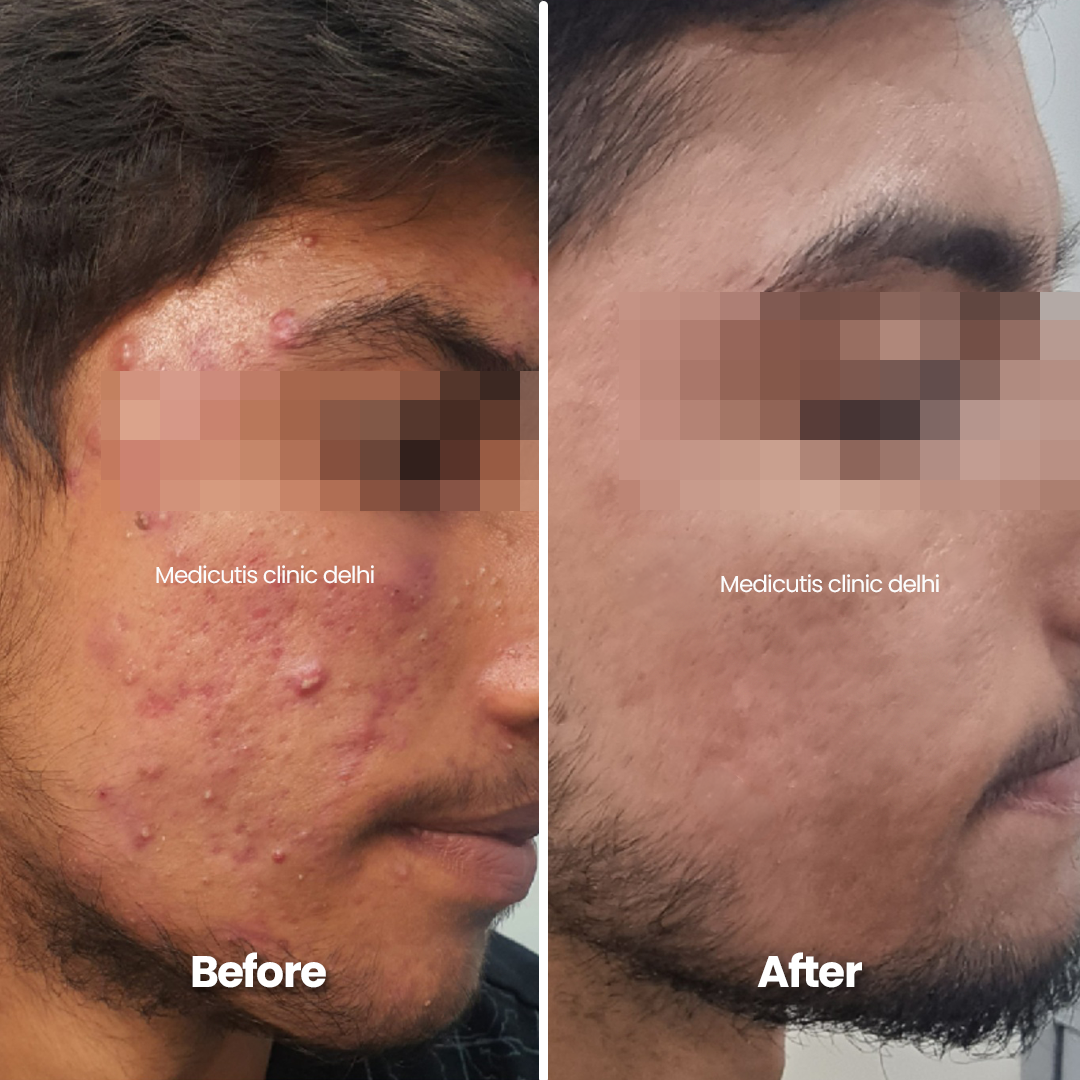 4 Edit Acne