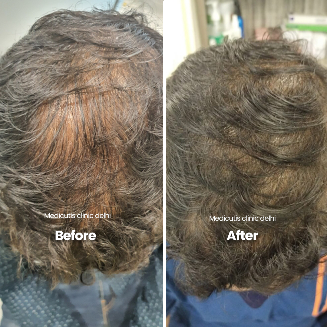 4 Hair Thinning