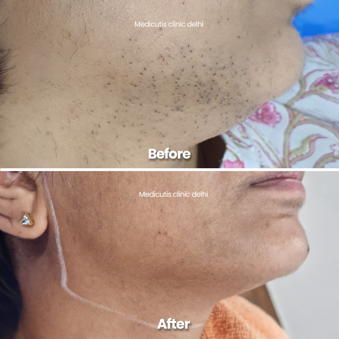 4 Laser for Unwanted Hair
