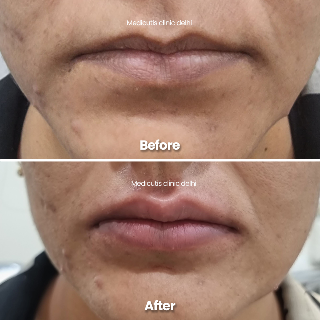 4 Lip Rejuvenation & Enhancement