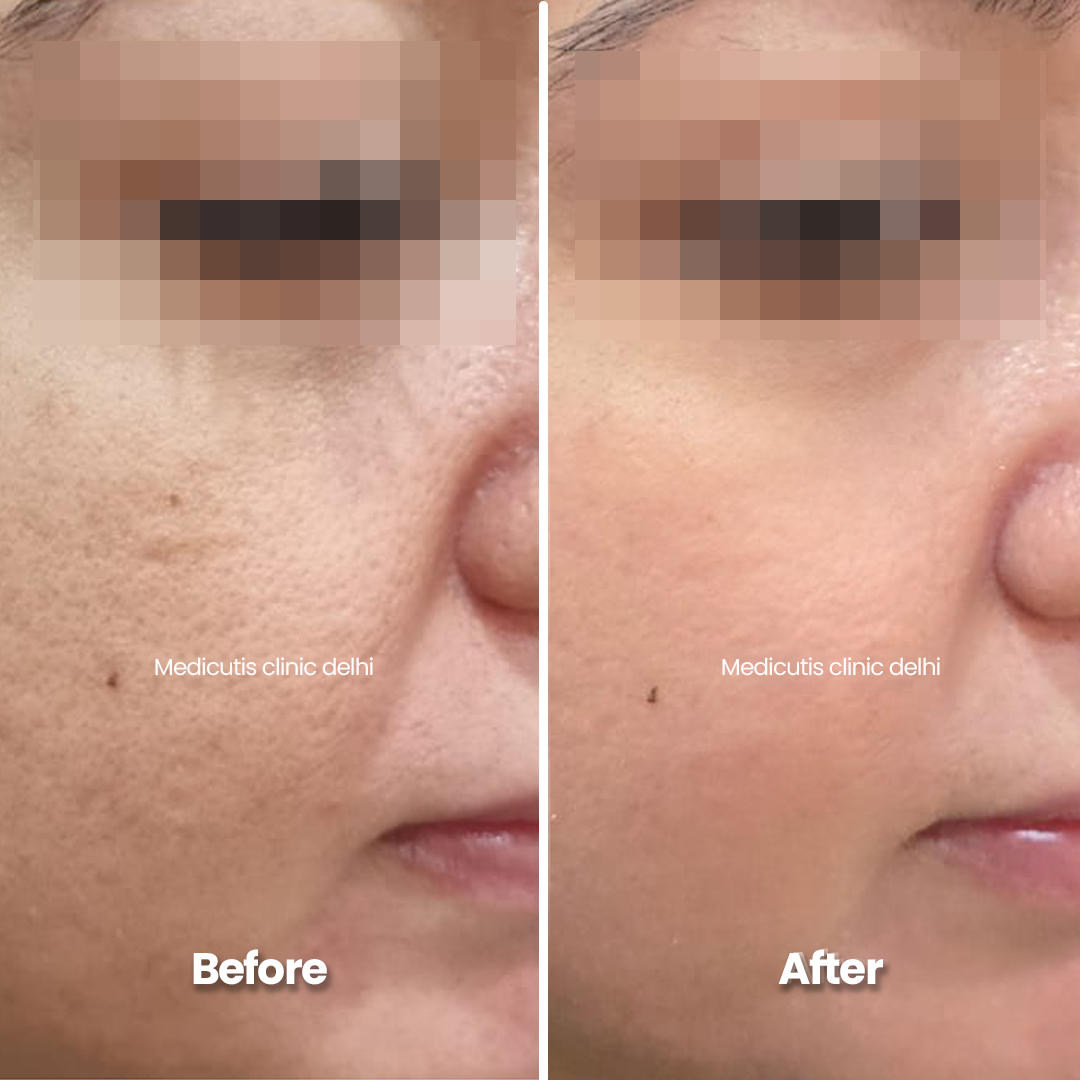 4 Skin Regeneration