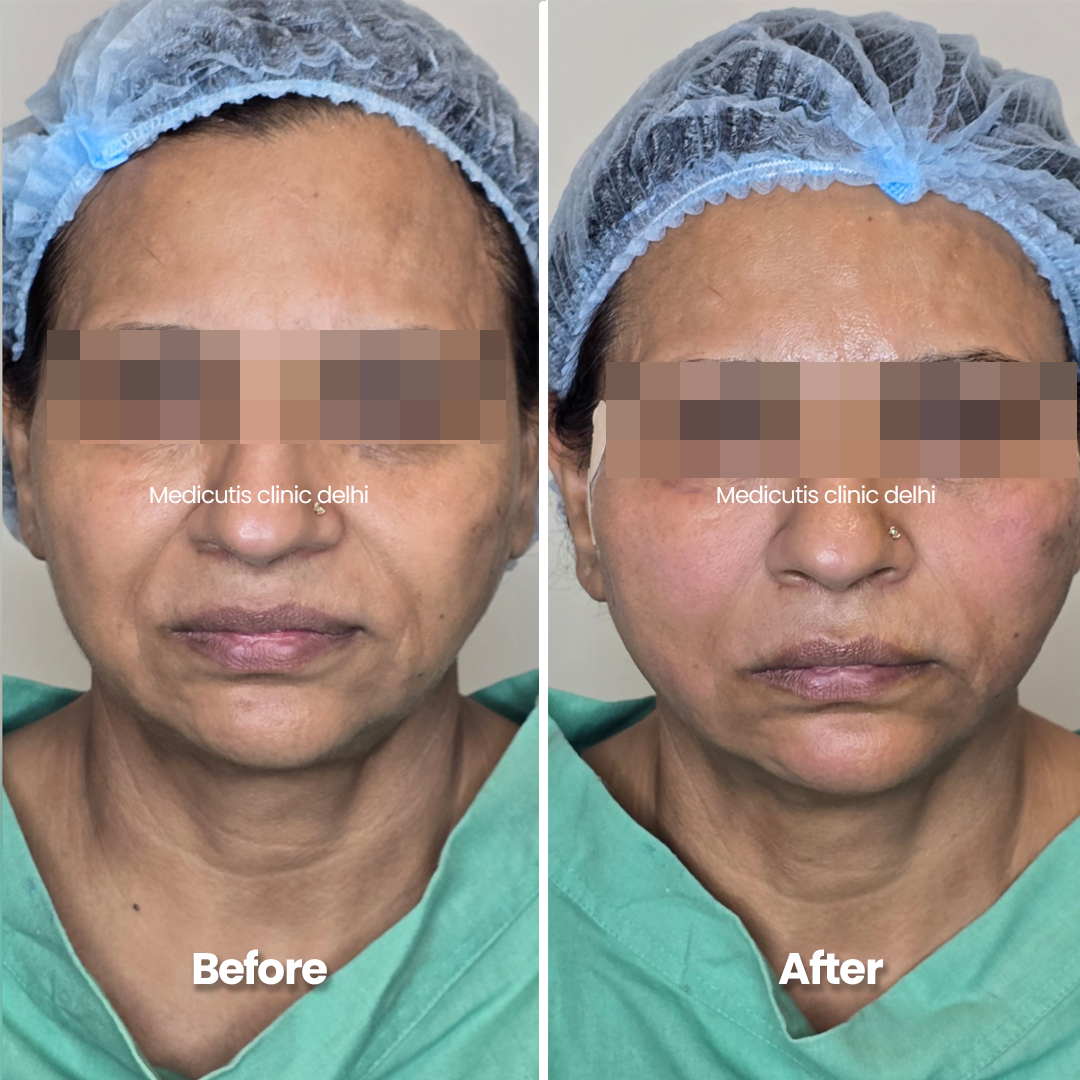 4 Skin Tightening & Lifting