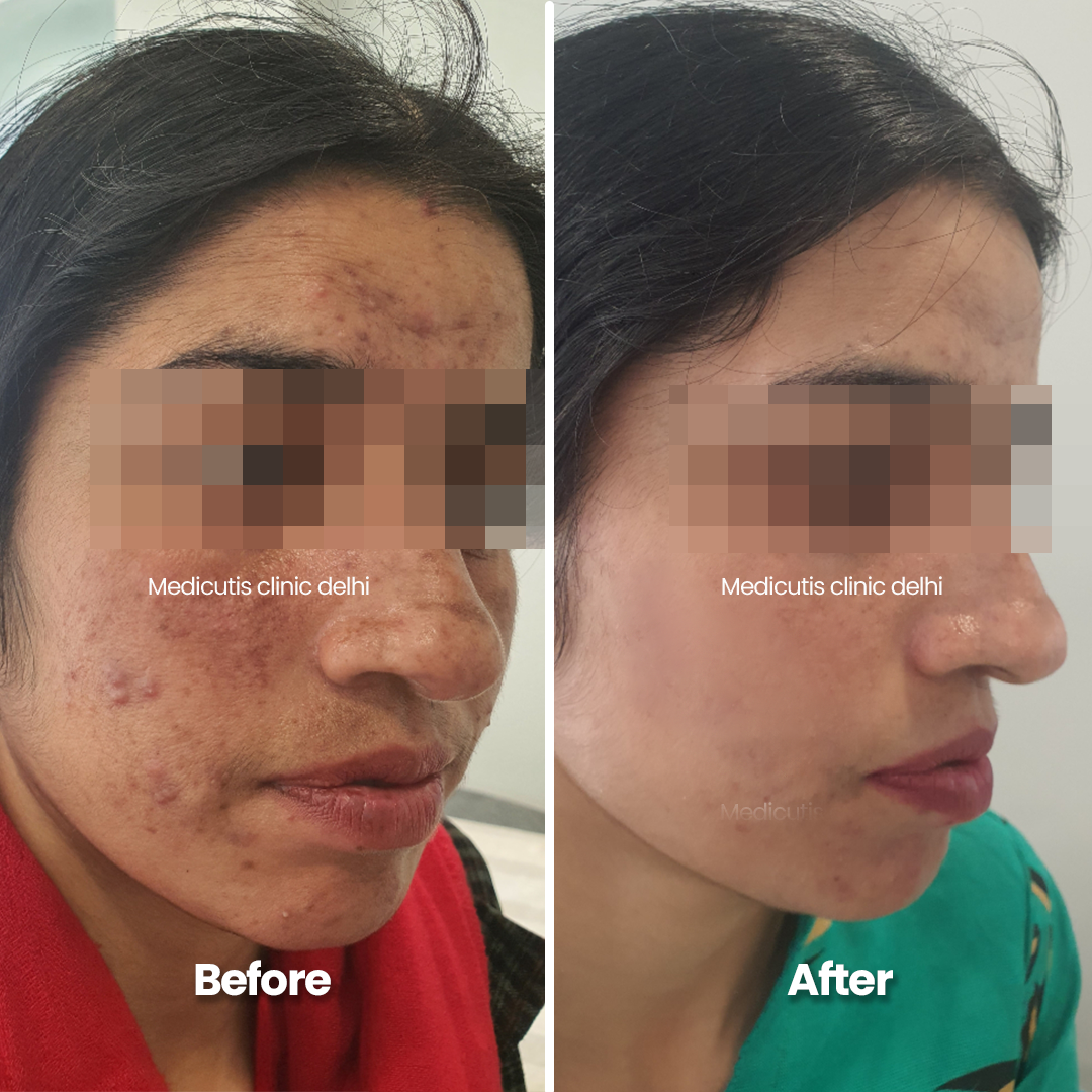 5 Acne Scars & Texture Correctionpng