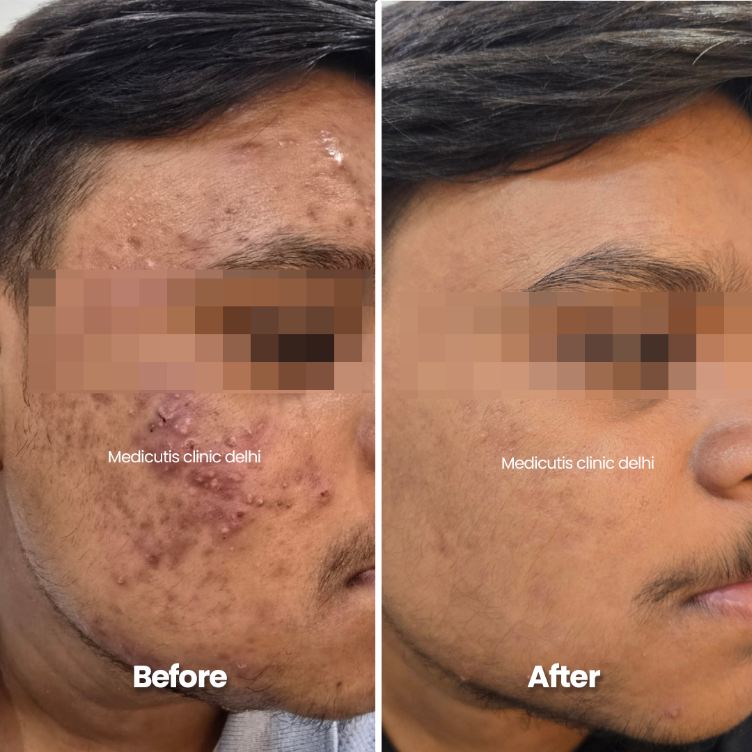 5 Edit Acne