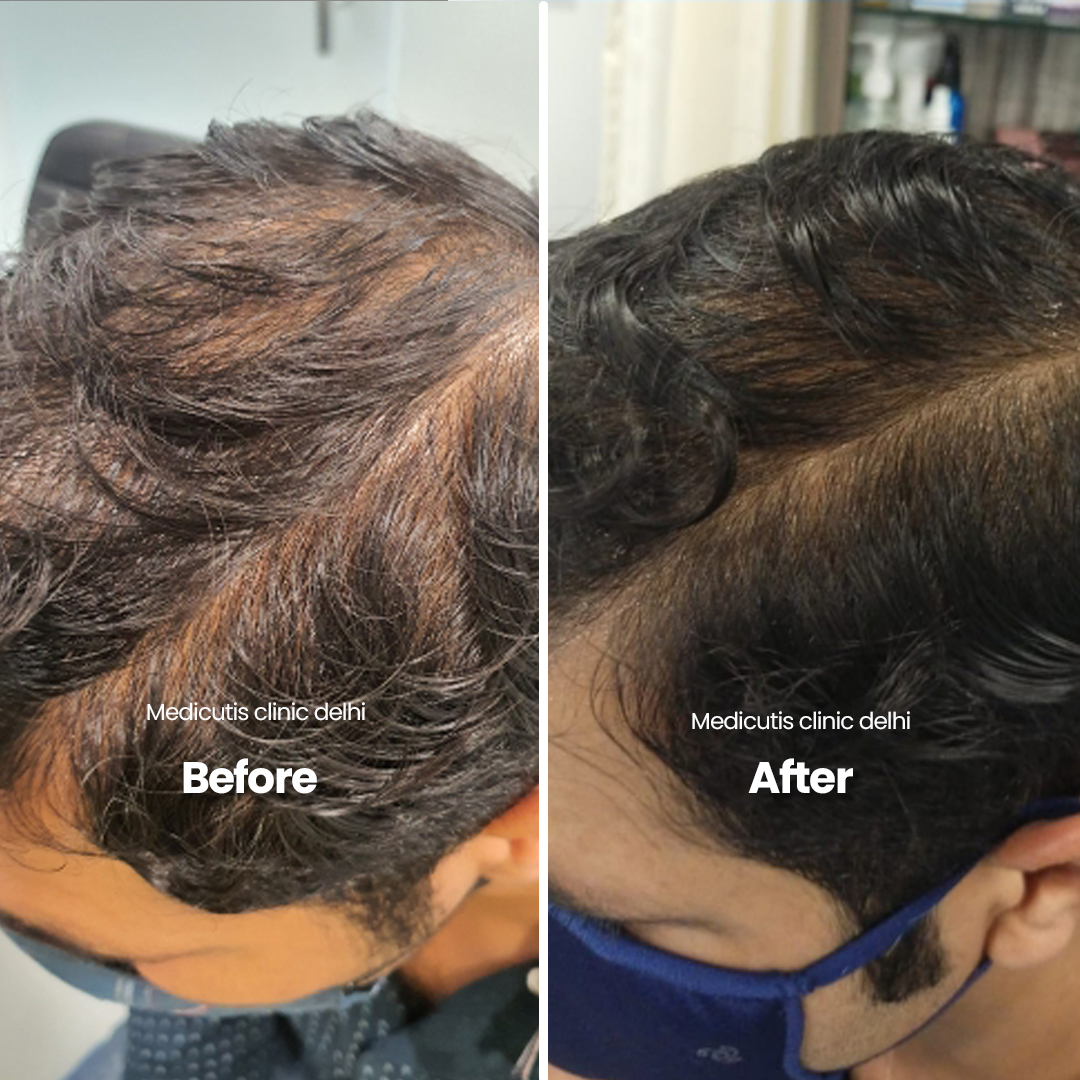 5 Hair Thinning