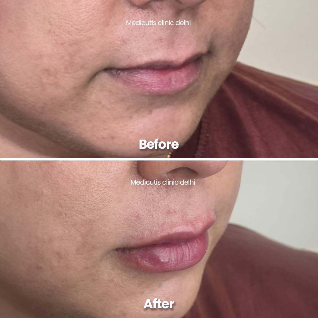 5 Lip Rejuvenation & Enhancement