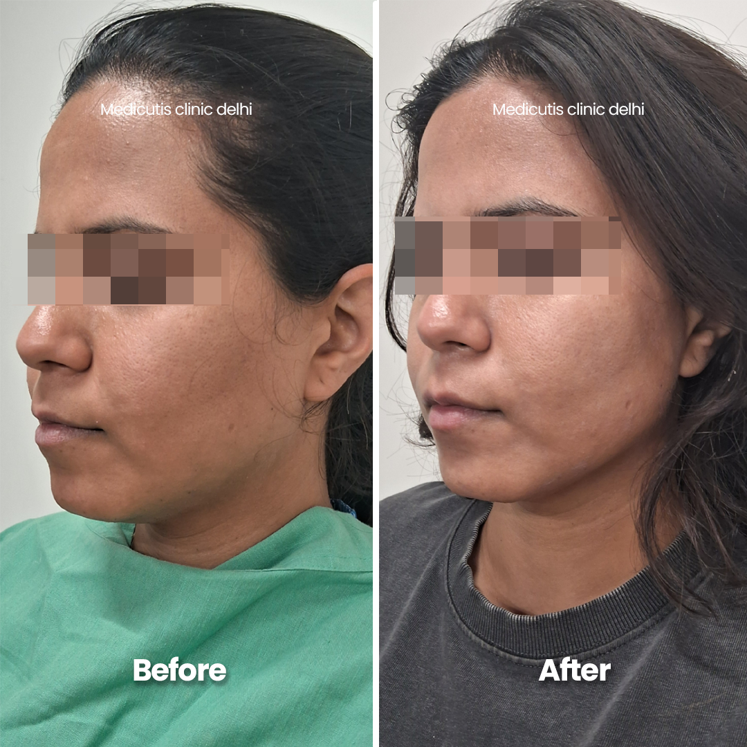 5 Skin Tightening & Lifting