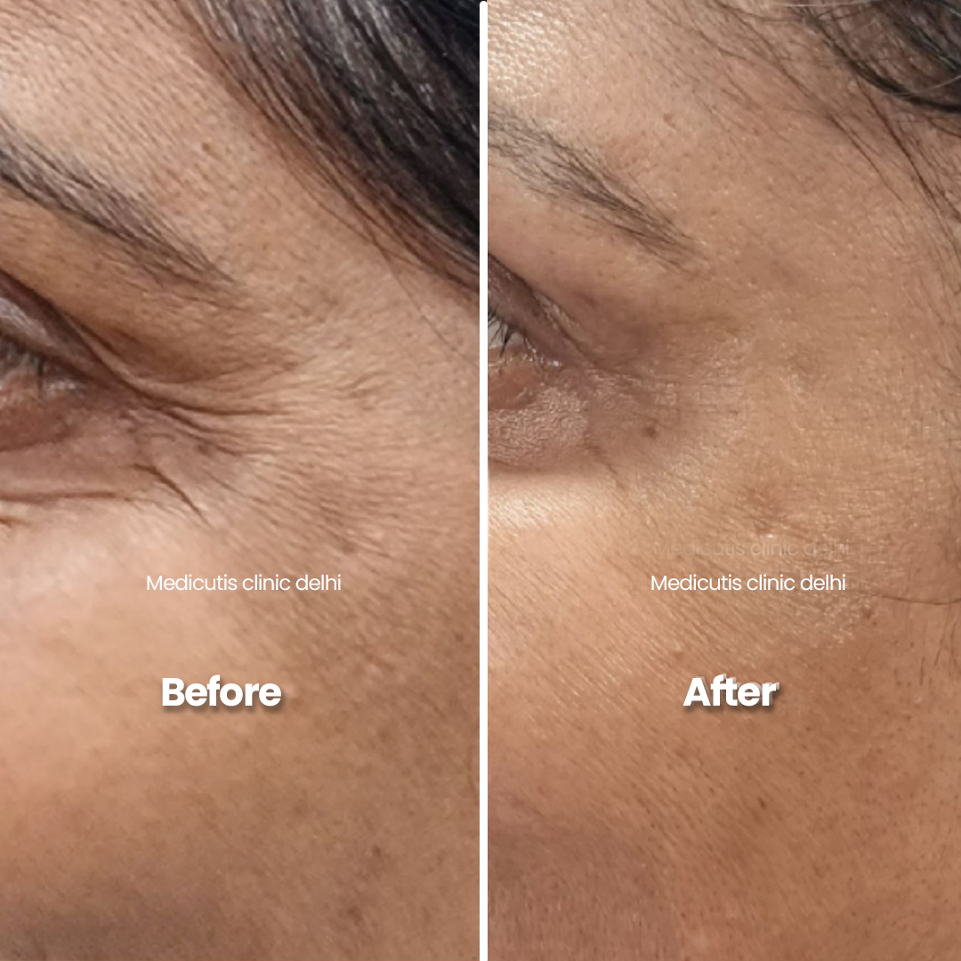 5 Wrinkles, Sagging & volume