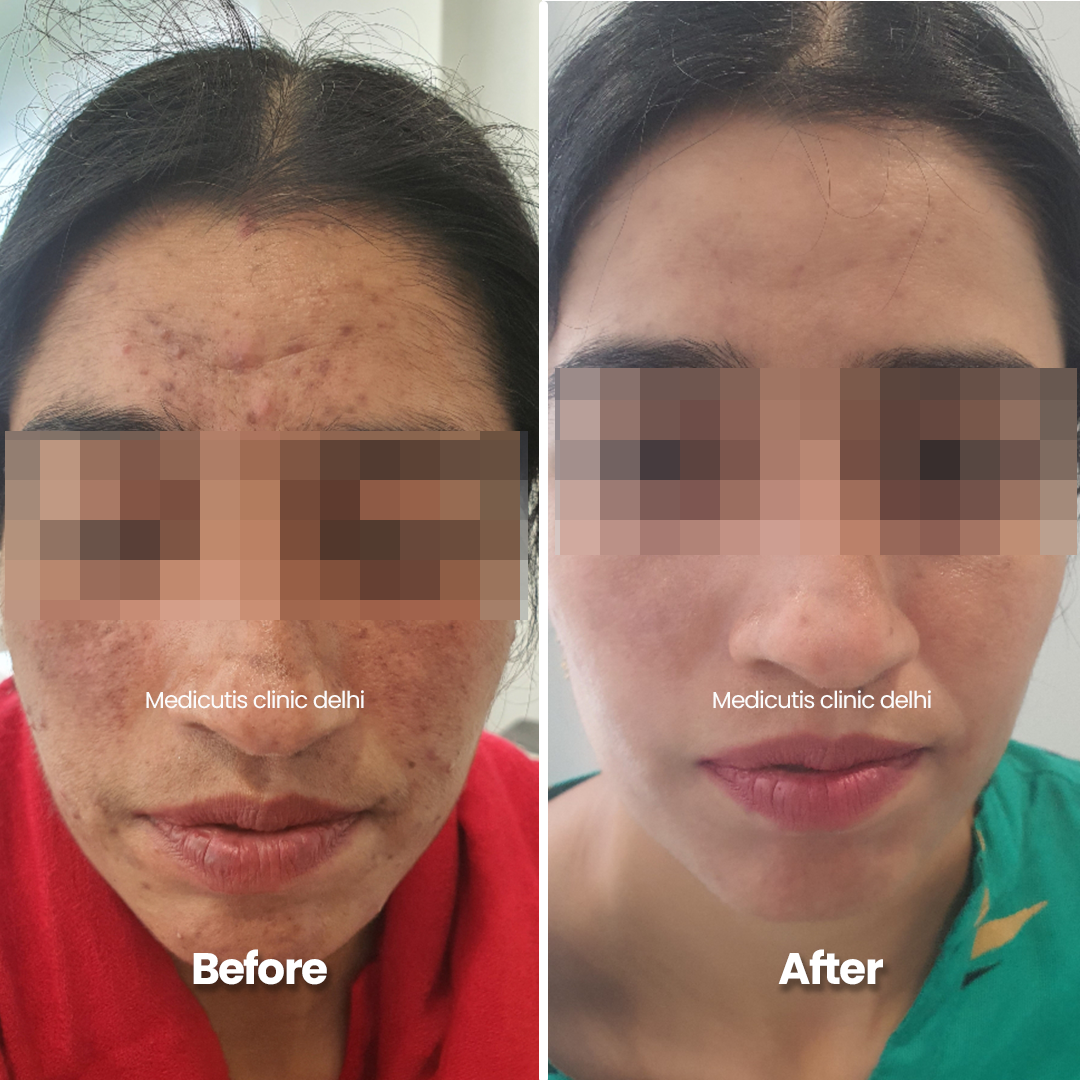6 Acne Scars & Texture Correction