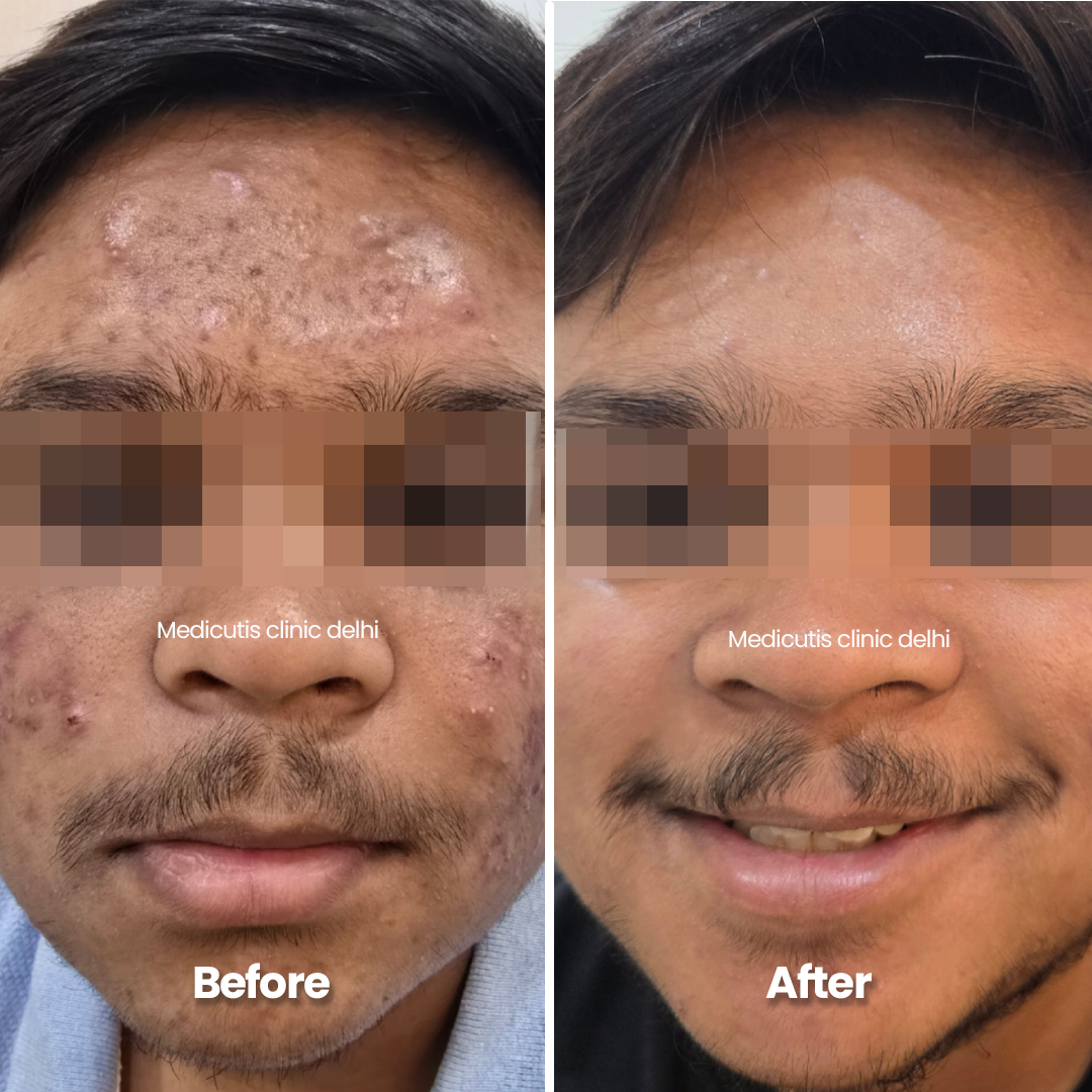 6 Edit Acne