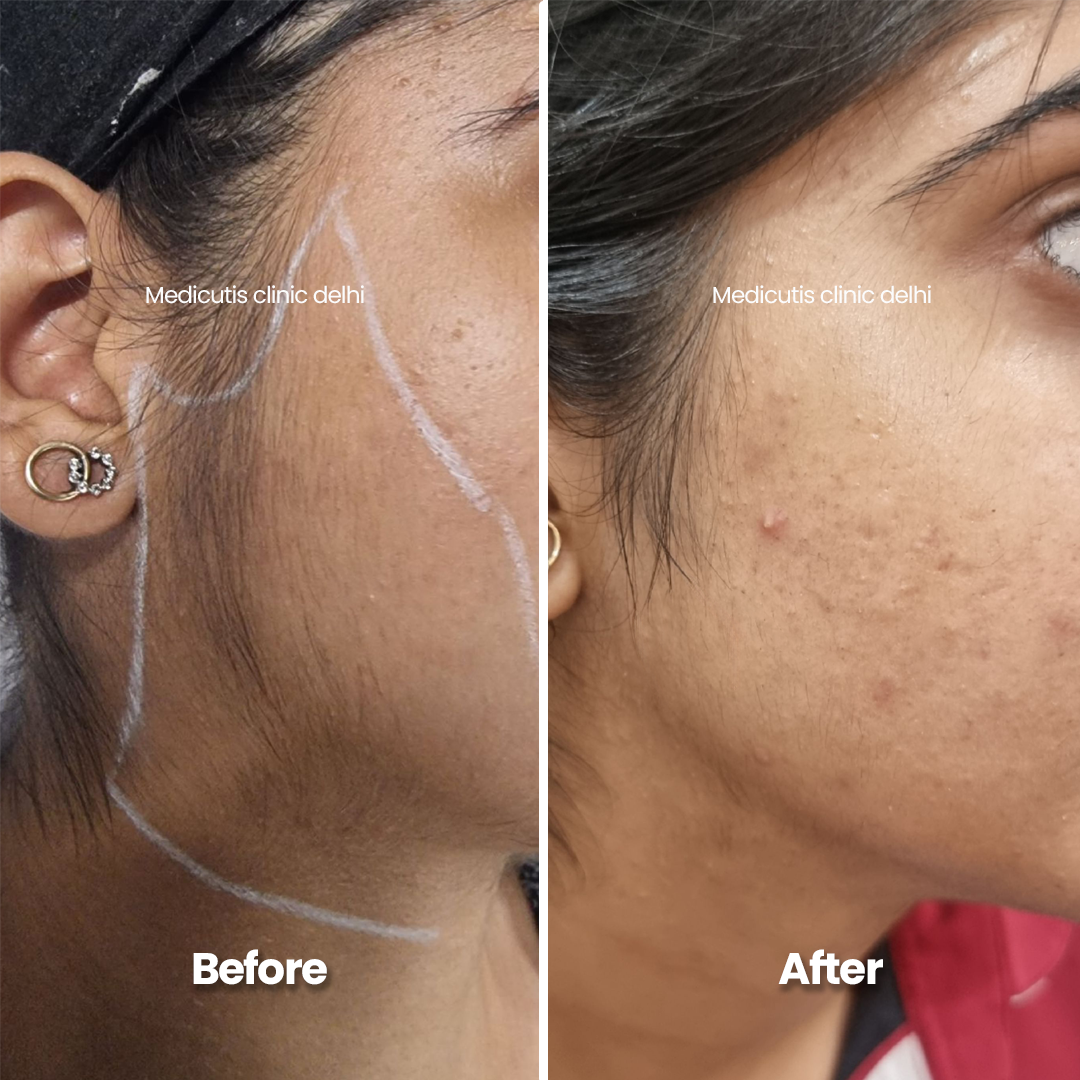 6 Laser for Unwanted Hair