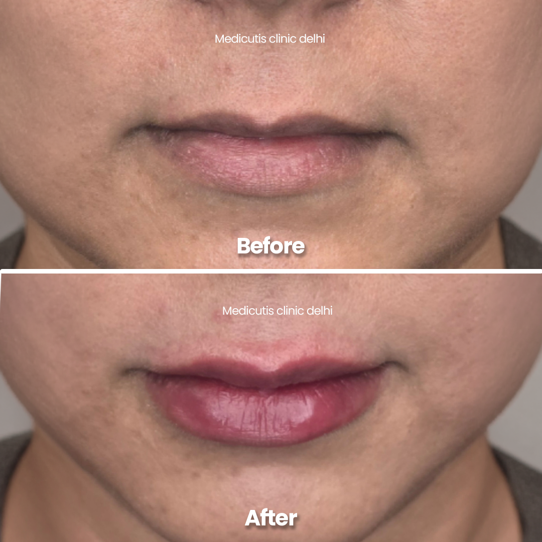 6 Lip Rejuvenation & Enhancement