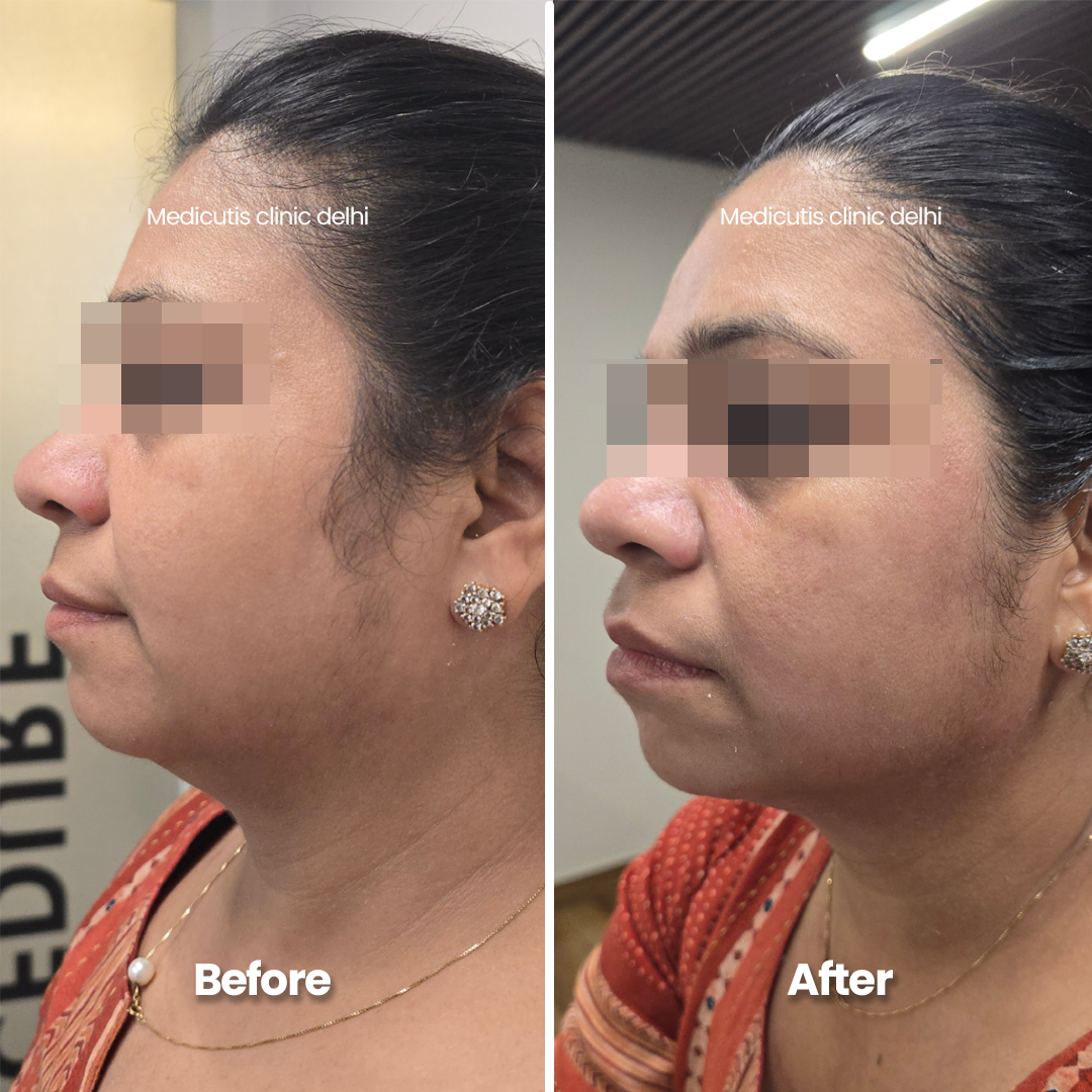 6 Skin Tightening & Lifting