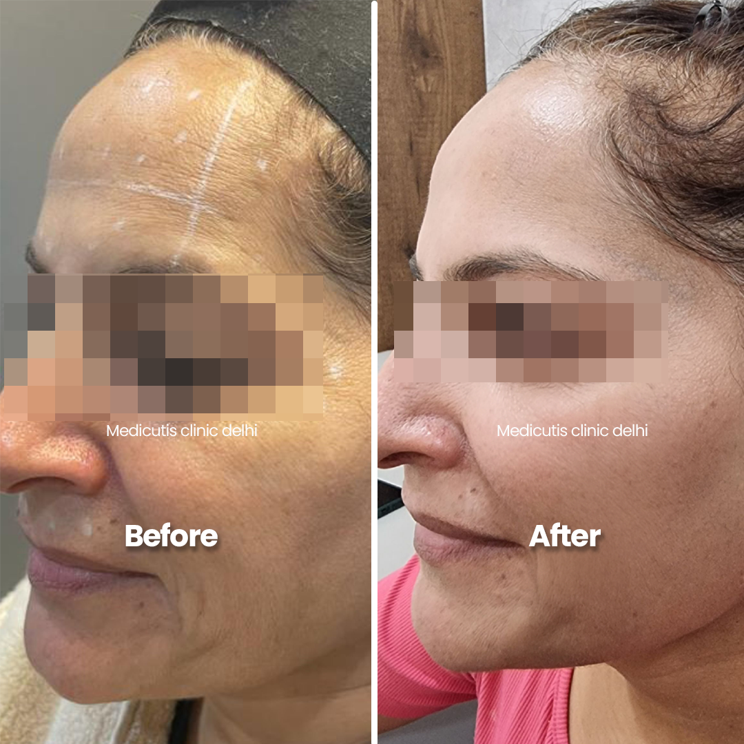 6 Wrinkles, Sagging & volume