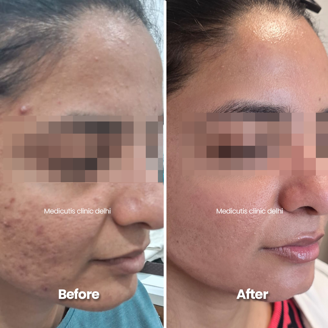 7 Acne Edit