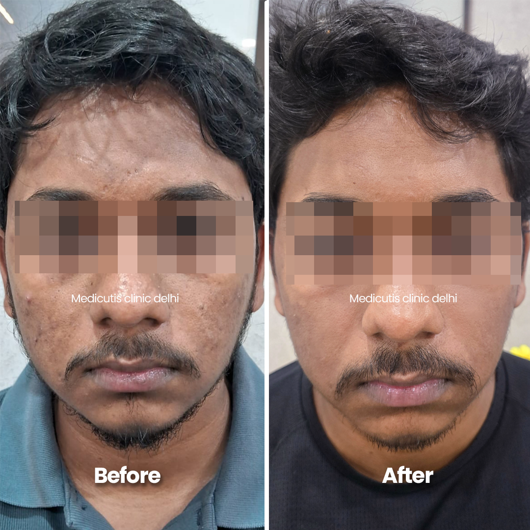 7 Acne Scars & Texture Correction