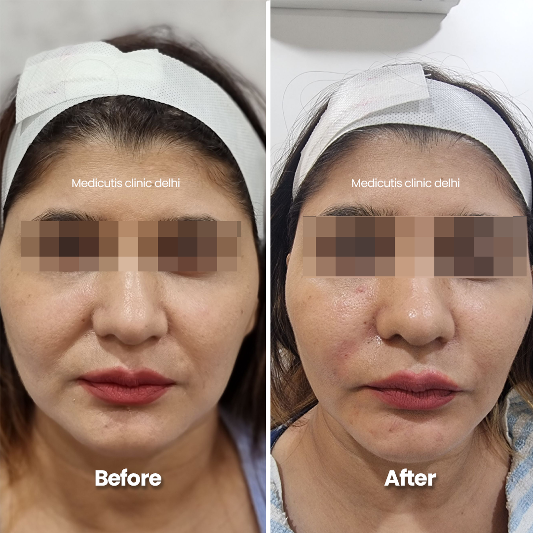 7 Skin Tightening & Lifting