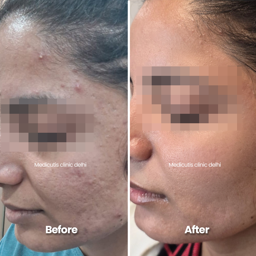 8 Acne Edit