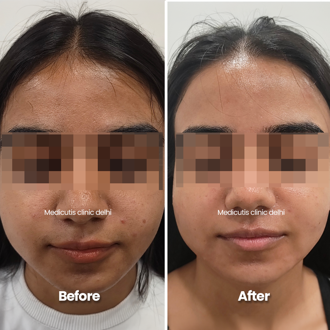 8 Acne Scars & Texture Correction