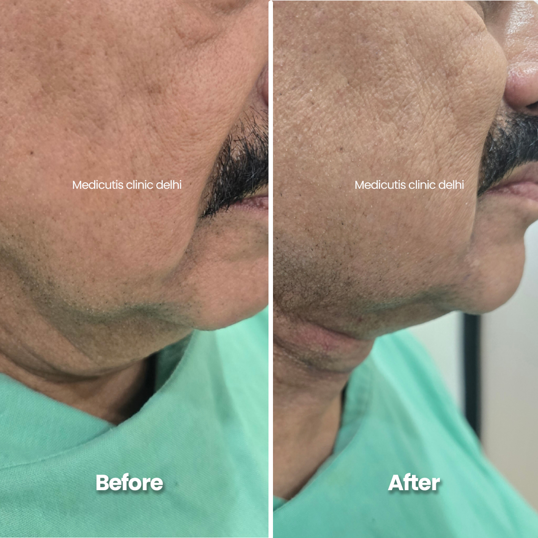 8 Skin Tightening & Lifting