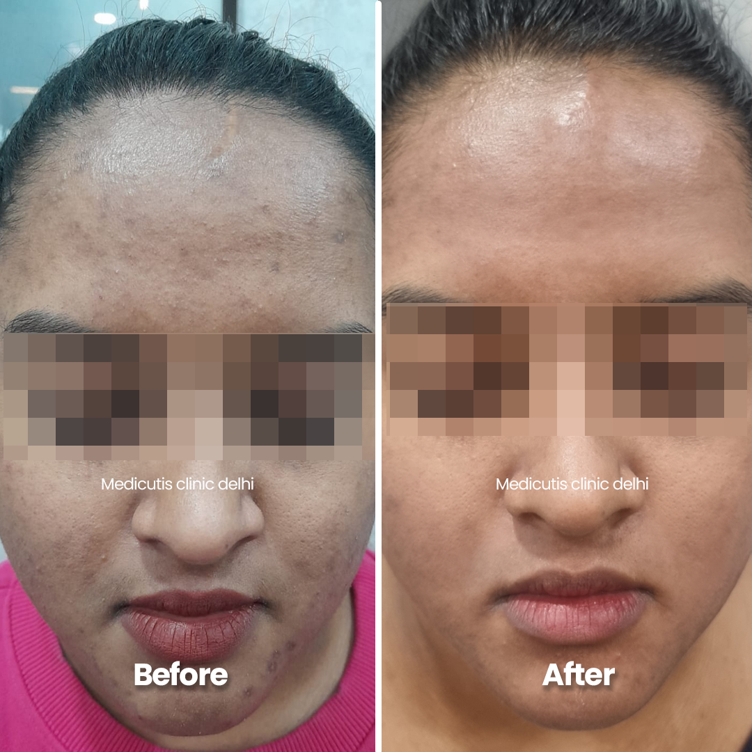 9 Acne Scars & Texture Correction